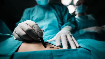 షాకింగ్ :17యేళ్ళ బాలిక కడుపులో రెండు కిలోల వెంట్రుకల గడ్డ.. !