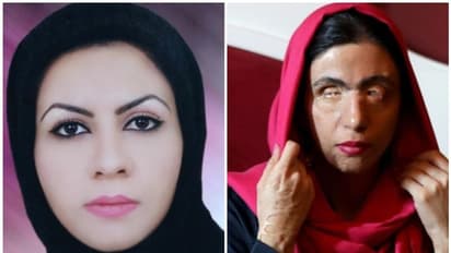 ആസിഡ് ആക്രമണത്തെ അതിജീവിച്ചു, വിധിയ്ക്ക് മുന്നിൽ തോൽക്കാൻ തയ്യാറായിരുന്നില്ല; മാസോമെയുടെ ജീവിതം ഇങ്ങനെ