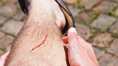 గద్వాల జిల్లాలో దారుణం.. గాయాలకు కుట్లకు బదులు ఫెవీక్విక్ తో అతుకులు.. !