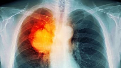 ശ്വാസകോശത്തിലെ ക്യാന്‍സര്‍; എന്തുകൊണ്ട് കണ്ടെത്താന്‍ വൈകുന്നു?