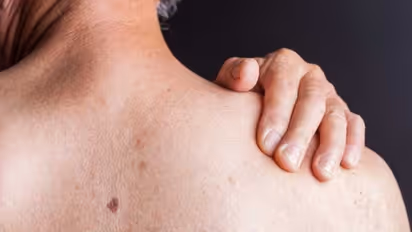 എച്ച്‌ഐവി ഇന്‍ഫെക്ഷന് ലക്ഷണങ്ങളുണ്ടോ? അറിയേണ്ട ചിലത്...