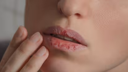 Chapped Lips : മഞ്ഞുകാലത്ത് ചുണ്ടുകള്‍ വരണ്ടുപൊട്ടുന്നത് തടയാം; ചെയ്യേണ്ടത്...