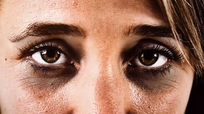 Tips to get rid of dark circles: கண்களில் கருவளையமா..? இதை ஒரு முறை ட்ரை பண்ணி பாருங்க..உடனடி தீர்வு உறுதி..