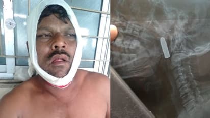 মুখের চোয়ালে আটকে গুলির খোল, দুষ্কৃতীদের ছিনতাইয়ে বাধা দেওয়ায় শুটআউট সাকরাইলে