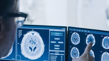 കൊവിഡ് 19 തലച്ചോറിനേയും ബാധിക്കുന്നു!; കണ്ടെത്തലുമായി ഗവേഷകര്‍