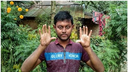 വിരലടയാളമില്ലാത്ത അപൂര്‍വരോഗം, പാസ്‌പോർട്ടും, ലൈസൻസുമടക്കം നിഷേധിക്കപ്പെട്ട ഒരു കുടുംബം