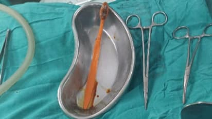 ब्रश कर रहा था शख्स, हुआ कुछ ऐसा की सीधा पेट में चला गया, एक्स-रे में भी नजर नहीं आया