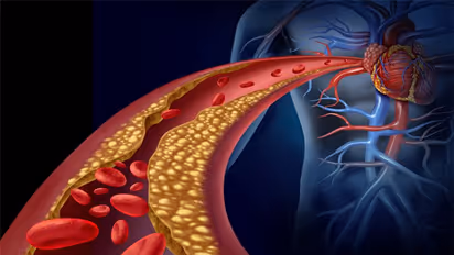 ರಕ್ತನಾಳಗಳಲ್ಲಿ ಕ್ಯಾಲ್ಸಿಯಂ ಸೇರಿದ್ರೆ ಹೃದಯಾಘಾತ ಚಾನ್ಸಸ್ ಜಾಸ್ತಿನಾ?