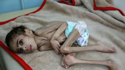 7 की उम्र के बच्चे का सिर्फ 7 किलो वजन, कंकाल में बदला शरीर... विकराल तस्वीर देख रह जाएंगे दंग