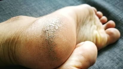 Prevent Crack Heels: শীতে ফাটা গোড়ালির সমস্যা, দূর করবে এই অব্যর্থ টিপসটি