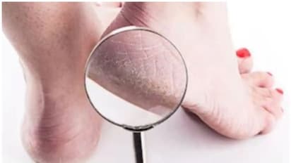 പാദങ്ങളിലെ വിണ്ടുകീറല് മാറാൻ രണ്ടുണ്ട് വഴി