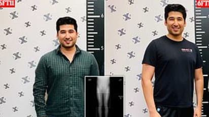 സങ്കല്‍പത്തിലെ 'ഹീറോ'യാകാന്‍ ഉയരം കൂട്ടൂന്ന ശസ്ത്രക്രിയയ്ക്ക് വിധേയനായി യുവാവ്