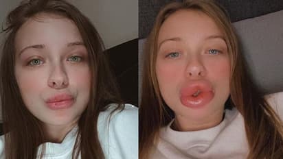 ചുണ്ട് ഭംഗിയാക്കാന് ചികിത്സയെടുത്തു; ഇനിയാര്ക്കും ഈ അവസ്ഥ വരരുതെന്ന് യുവതി