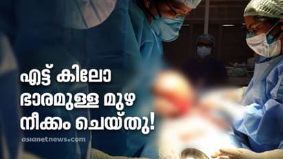 64-കാരിയുടെ വയറ്റിൽ നിന്ന് നീക്കം ചെയ്തതത് എട്ട് കിലോ തൂക്കമുള്ള മുഴ; ശസ്ത്രക്രിയ തിരുവനന്തപുരം എഎസ്എടിയിൽ