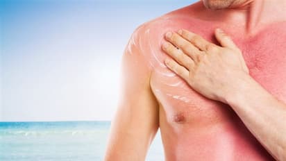 ಇದನ್ನು ಉಪಯೋಗಿಸಿದ್ರೆ, ಬೇಸಿಗೆಯಲ್ಲಿ Sunburn ಸಮಸ್ಯೆ ಕಾಡೋಲ್ಲ! 