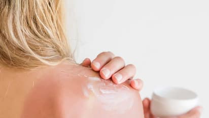 Here are effective remedies you can try at home for sunburn