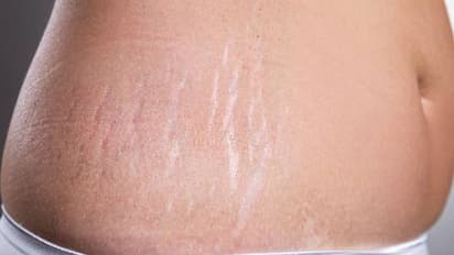 ചര്മ്മത്തിലെ സ്ട്രെച്ച് മാർക്ക് മാറാൻ പത്ത് എളുപ്പ വഴികൾ...