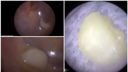 രൂക്ഷമായ ചെവിവേദന; മൂന്നുവയസുകാരന്‍റെ ചെവിയില്‍ നിന്ന് പുറത്തുവന്ന വസ്തു കണ്ട് അമ്പരന്ന് ഡോക്ടര്‍