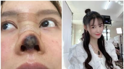 മൂക്കിന് ഭംഗി കൂട്ടാൻ വേണ്ടി കോസ്മറ്റിക് സർജറി ചെയ്തു, പിന്നീട് സംഭവിച്ചത്...