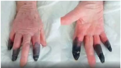 കൊവിഡ് ബാധിച്ച 86കാരിയുടെ വിരലുകള്ക്ക് കറുത്ത നിറം; മുറിച്ച് മാറ്റി ഡോക്ടര്മാര്