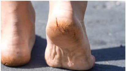 కాళ్ల పగుళ్లు బాధిస్తున్నాయా..? ఈ చిట్కాలతో పరిష్కారం