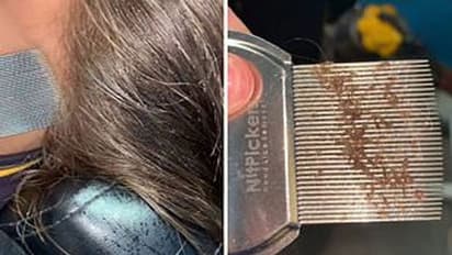 পুজোর আগেই সন্তানের মাথা থেকে দূর করুন উকুন, রইল সহজ টিপস