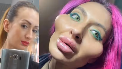 ശസ്ത്രക്രിയയ്ക്ക് മുമ്പുള്ള ചിത്രം പങ്കുവച്ച് ലോകത്തിലെ ഏറ്റവും വലിയ കവിളുകളുള്ള മോഡല്!