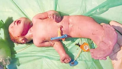 చేప ఆకారంలో శిశువు జననం... పుట్టిన కాసేపటికే..