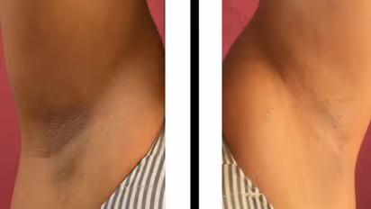 அக்குள் கருப்பா அசிங்கமா இருக்கா.. தயிர் மட்டும் போதும்.. வெறும் 5 நிமிடங்களில் மாறும் அதிசயம்