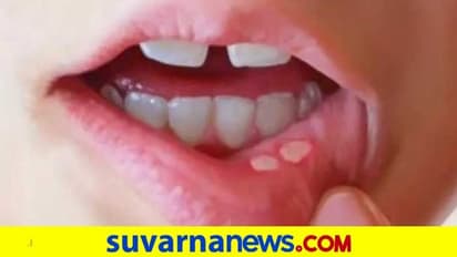 ಬಾಯಿ ಹುಣ್ಣಿಗೆ ಬೈ ಬೈ ಹೇಳೋ ಮದ್ದುಗಳು ಇಲ್ಲಿವೆ ನೋಡಿ…