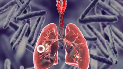 What is Tuberculosis (TB)? Know symptoms, treatment and how it spreads