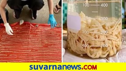 ಗ್ಯಾಸ್ಟ್ರಿಕ್ ಪ್ರಾಬ್ಲೆಂ: ವ್ಯಕ್ತಿಯ ಗುದನಾಳದಲ್ಲಿತ್ತು 18 ಮೀಟರ್ ಉದ್ದದ ಲಾಡಿಹುಳ