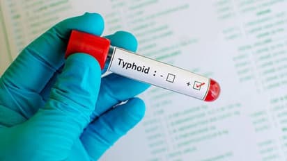 typhoid