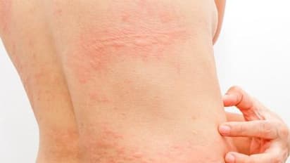 ഫുഡ് അലർജി ; പ്രധാനപ്പെട്ട ആറ് ലക്ഷണങ്ങൾ