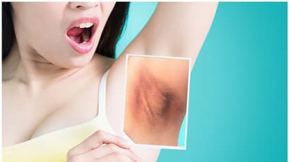 കക്ഷത്തിലെ കറുപ്പ് നിറം അകറ്റാൻ ഇതാ മൂന്ന് വഴികൾ