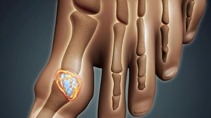 গেঁটে বাতের সমস্যায় ভুগছেন, ব্যাথা নিয়ন্ত্রণে রাখতে মেনে চলুন এই নিয়মগুলি