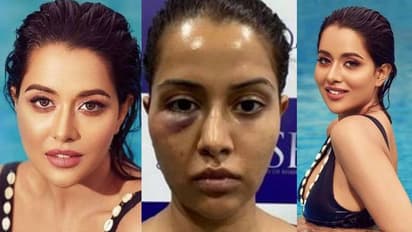 ത്വക്ക് ചികിത്സ പിഴച്ചു; നീരു വന്ന ചിത്രം പങ്കുവച്ച് നടി