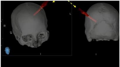 തലച്ചോറില്‍ മരക്കഷണം തുളച്ചുകയറി; യുവാവിന്‍റെ ജീവന്‍ രക്ഷിക്കാന്‍ മണിക്കൂറുകള്‍ നീണ്ട ശസ്ത്രക്രിയ