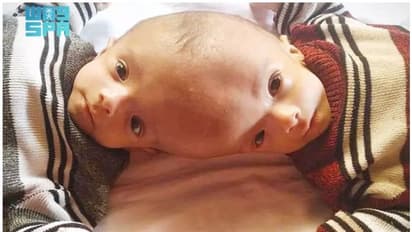 യെമനി സയാമീസ് ഇരട്ടകള്‍ക്ക് സൗദിയുടെ കാരുണ്യം