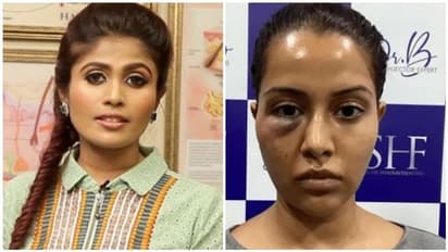 ரைசா முகம் வீங்க காரணம் என்ன?... முதன் முறையாக  மருத்துவர் பைரவி வெளியிட்ட உண்மை... அதிர்ச்சியான மறுபக்கம்!