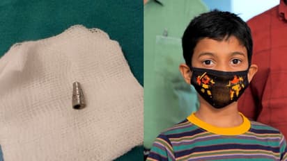 ഒരുമാസത്തിലേറെയായി മാറാത്ത ചുമ, പരിശോധനയില് ശ്വാസകോശത്തില് കണ്ടെത്തിയത് പേനയുടെ നിബ്ബ്