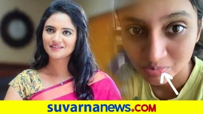 ನಟಿ ರಂಜನಿ ತುಟಿಯಲ್ಲಿ ಗಾಯದ ಗುರುತು..! ಏನಾಯ್ತು ?