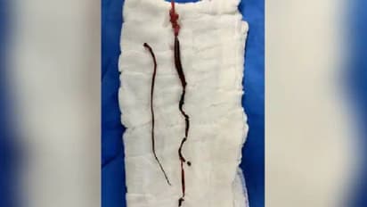 കൊവിഡ് രോഗികളില്‍ രക്തം കട്ട പിടിക്കുന്നതും ഹൃദയാഘാതം സംഭവിക്കുന്നതും; അറിയേണ്ട കാര്യങ്ങള്‍...