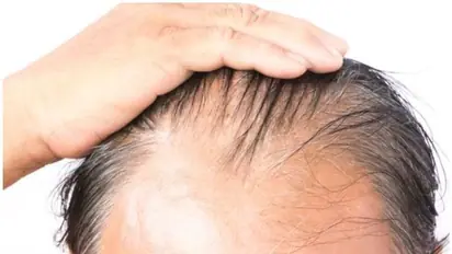 കൊവിഡ് 19; കഷണ്ടിയുള്ള പുരുഷന്മാരുടെ ശ്രദ്ധയ്ക്ക്;  പഠനം പറയുന്നത്