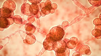 హైదరాబాద్ లో బ్లాక్ ఫంగల్ ఇన్ ఫెక్షన్ టెర్రర్..   కరోనా నుంచి కోలుకున్నవారిలో..