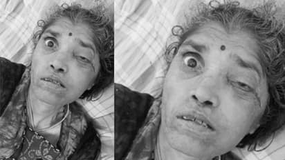 గుంటూరులో బ్లాక్ ఫంగస్ కలకలం: సుల్తానాబాద్ మహిళకు లక్షణాలు