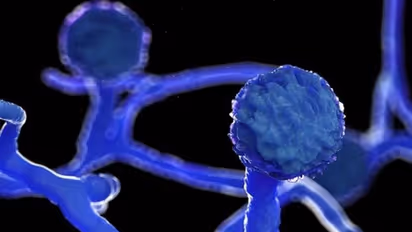 വീണ്ടും ബ്ലാക്ക് ഫംഗസ് മരണം; പാലക്കാട് ചികിത്സയിലായിരുന്ന വീട്ടമ്മ മരിച്ചു