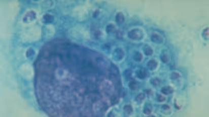 బ్లాక్‌ఫంగస్‌ బాధితులకు ఊరట.. ఈ ఆసుపత్రుల్లో ఉచిత చికిత్స, ఏపీ సర్కార్ ఆదేశాలు