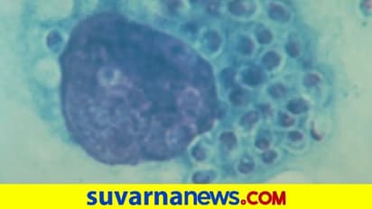 ಗುಪ್ತಾಂಗ, ಚರ್ಮ, ಮೆದುಳಿಗೆ ಹಾನಿ, ಬ್ಲ್ಯಾಕ್ ಫಂಗಸ್ಗಿಂತಲೂ ಡೇಂಜರ್ ಈ ವೈಟ್ ಫಂಗಸ್!