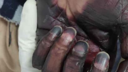 ಬ್ಲ್ಯಾಕ್ ಫಂಗಸ್ ಭಾರೀ ಏರಿಕೆ: 3 ವಾರದಲ್ಲಿ 2,100 ಬಲಿ!